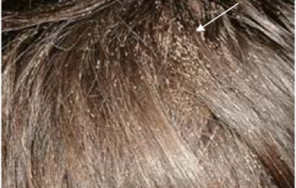 Head Lice Infestation