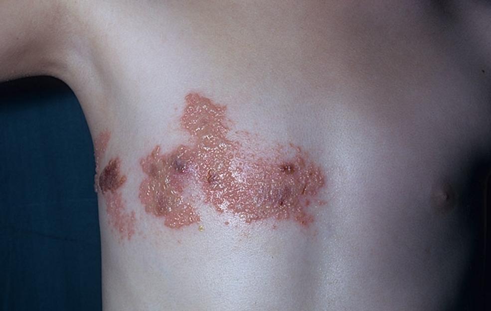 How long is shingles contagious?