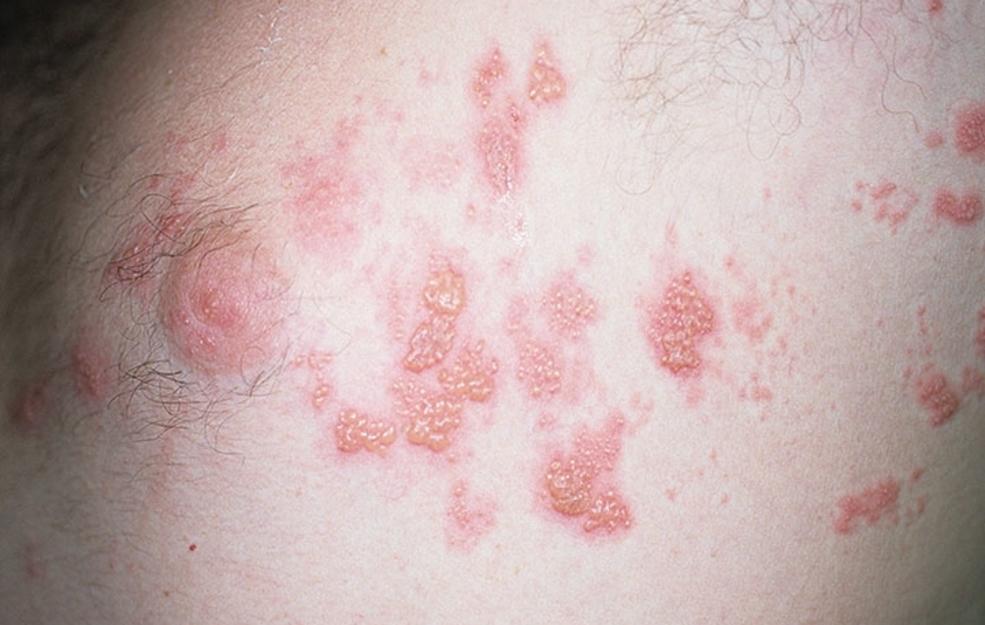 How to prevent spreading shingles