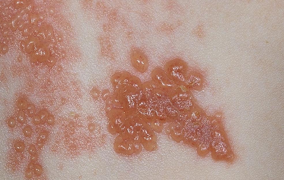 If you have shingles, you should avoid