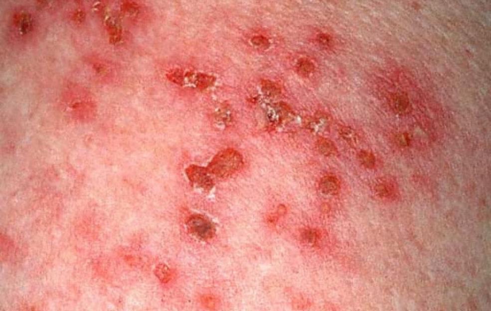 When is shingles contagious?