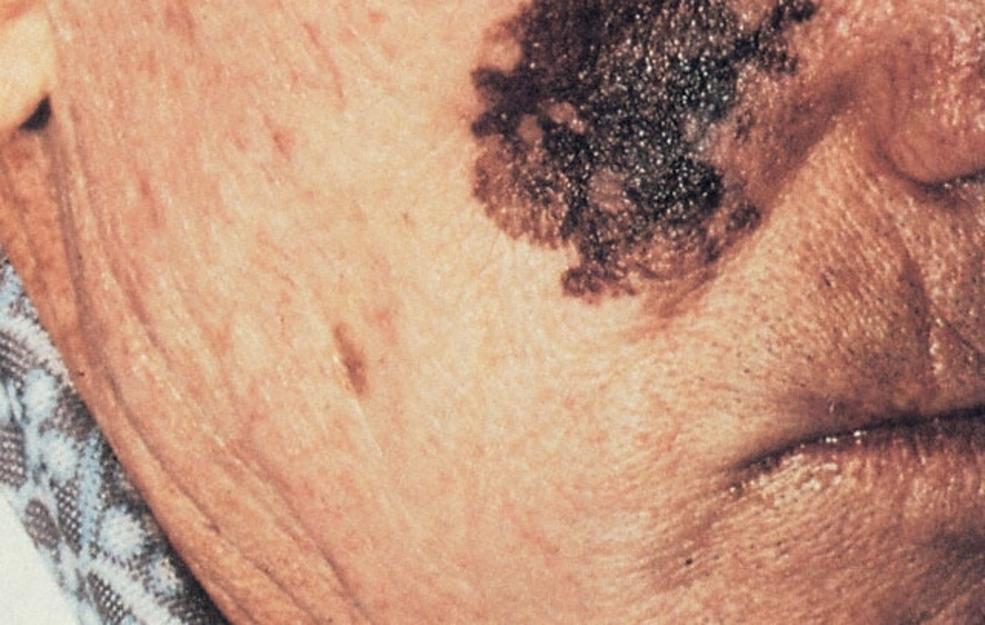 Melanoma on face