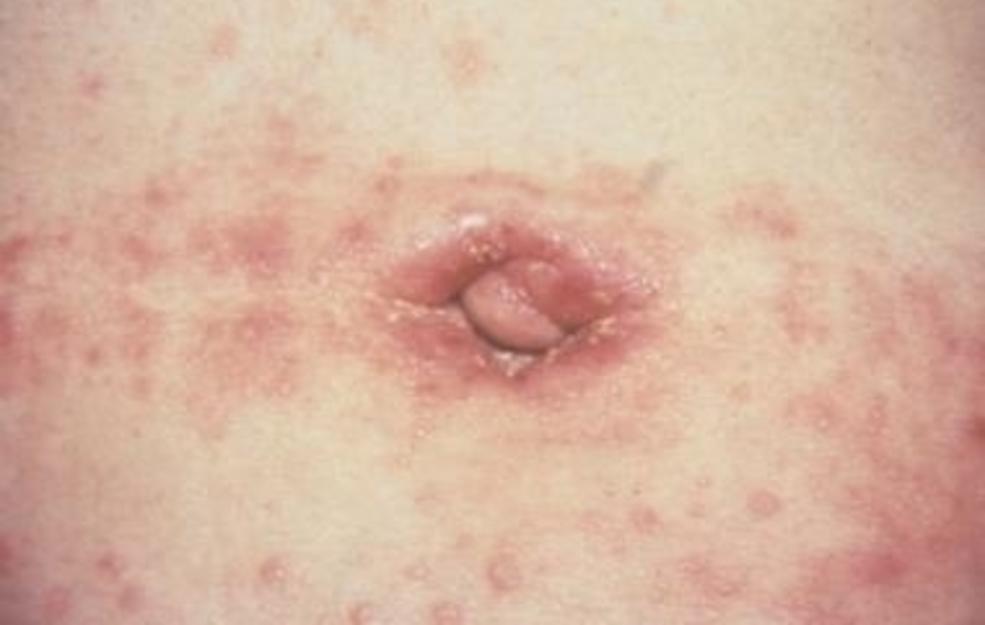 Recurring Vaginal and UTIs