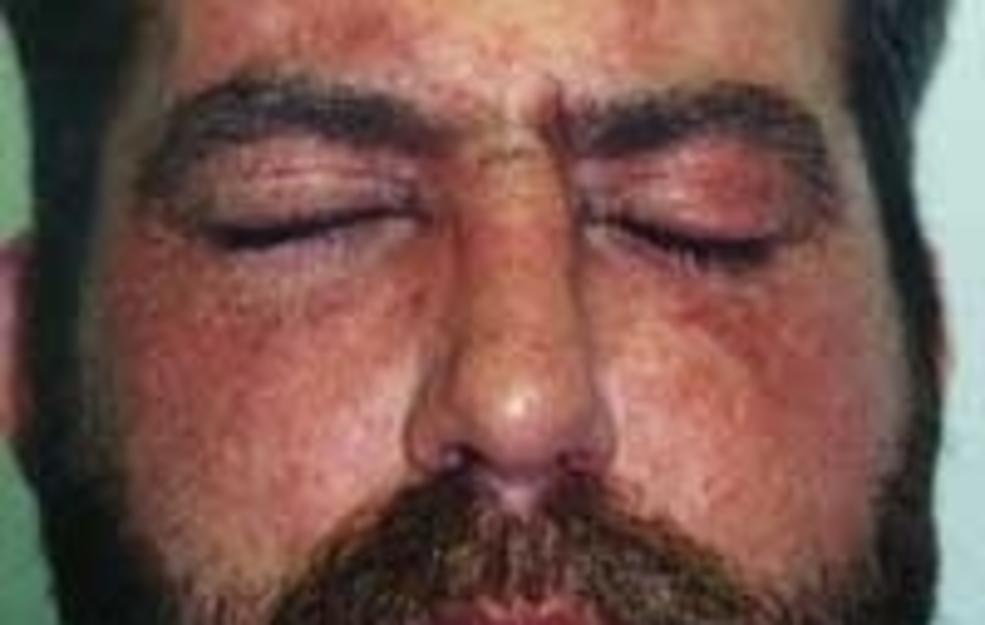 Allergic reactions