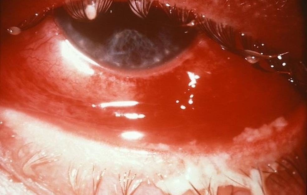 Conjunctivitis causes