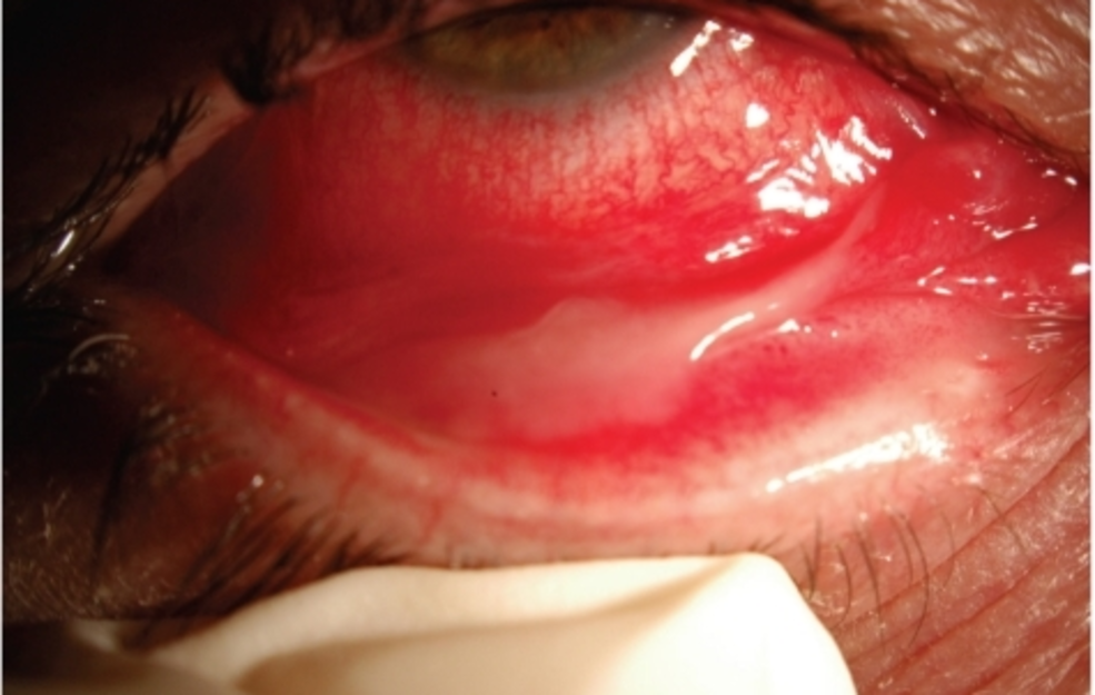 What is conjunctivitis?