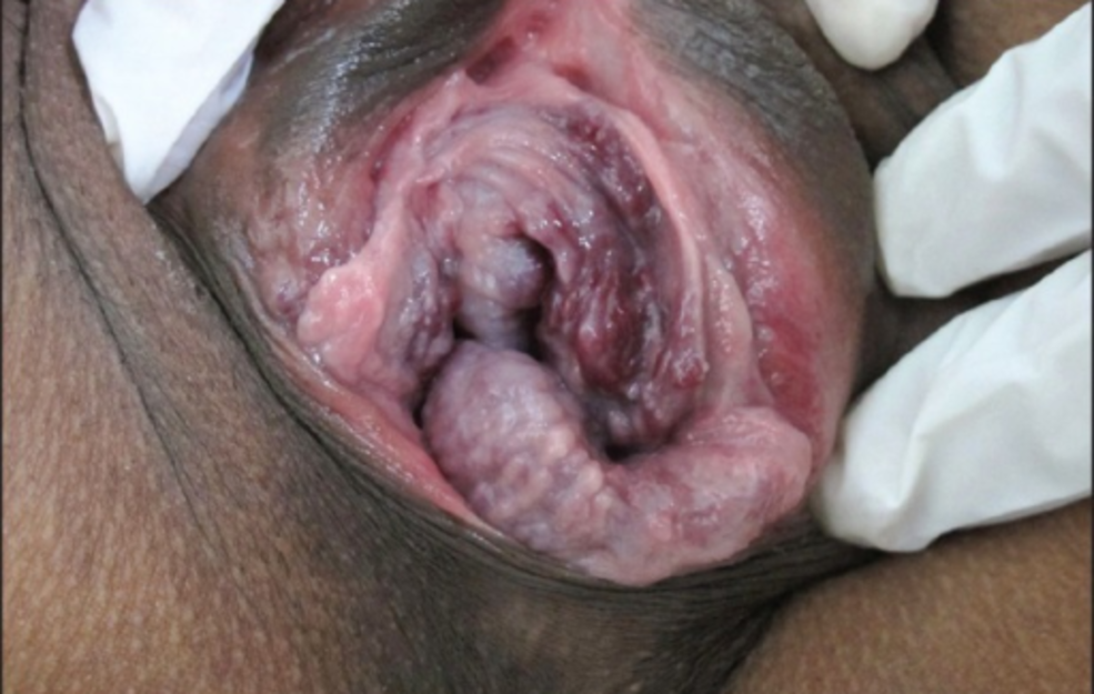 Inflammation