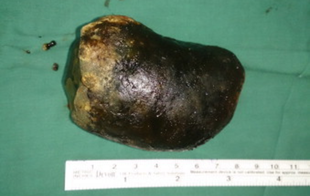 How to treat cholelithiasis