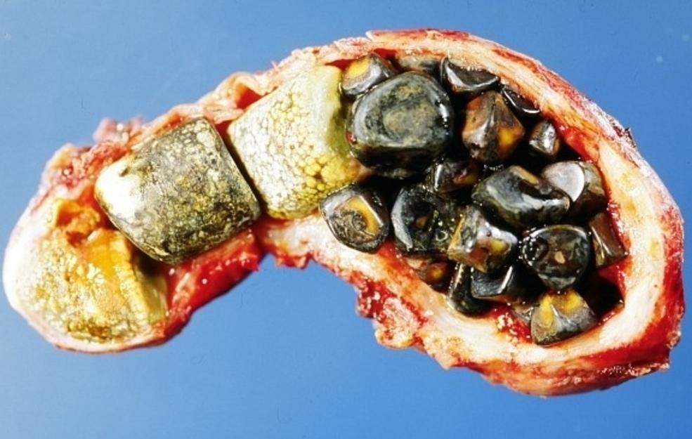 What is cholelithiasis?