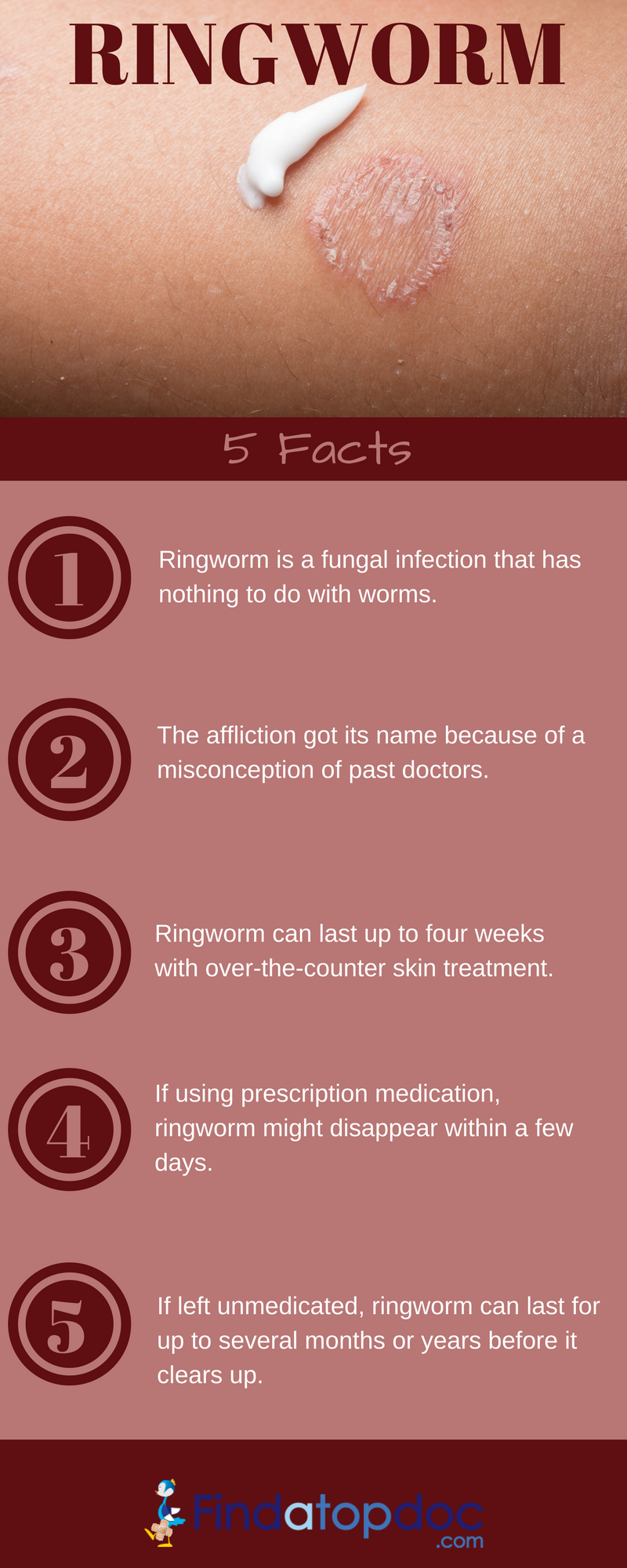 5 Facts About Ringworm