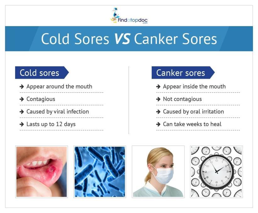 Cold Sores vs. Canker Sores