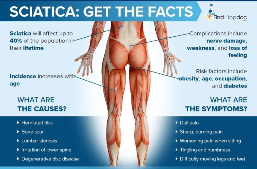 Sciatica