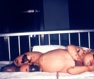 Viral Meningitis