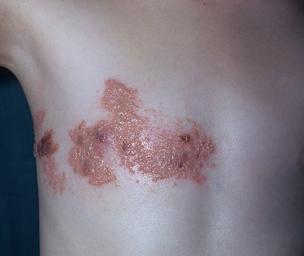 How long is shingles contagious?