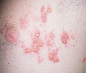 How to prevent spreading shingles