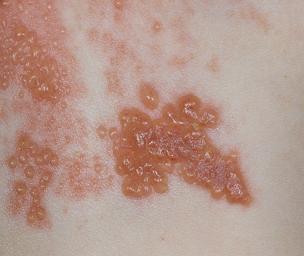 If you have shingles, you should avoid