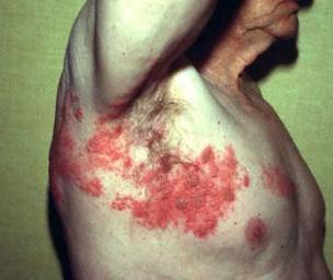 What is shingles?