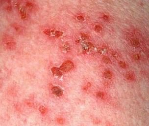 When is shingles contagious?