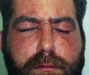 Allergic reactions