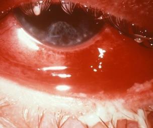 Conjunctivitis causes