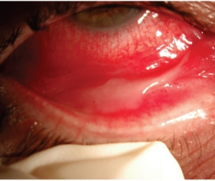 What is conjunctivitis?