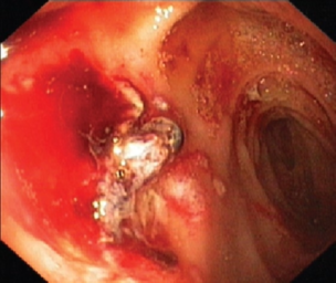 What causes stomach ulcers?