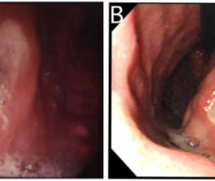What is a stomach ulcer?