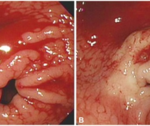 Where can you find stomach ulcers?