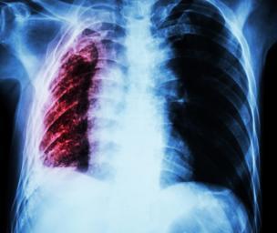 Atelectasis causes