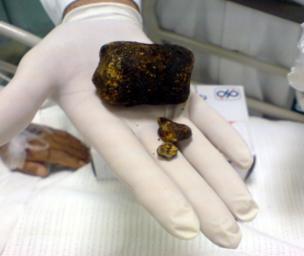 Cholelithiasis symptoms