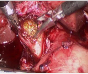 Cholelithiasis treatment