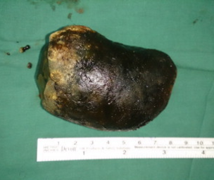 What does cholelithiasis look like?