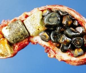 What is cholelithiasis?