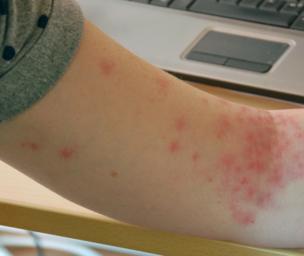 Common Side Effects pt. 3